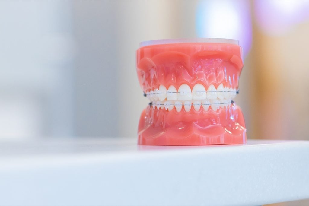 Ceramic Braces Witchita, KS Clear Braces Smith Orthodontics